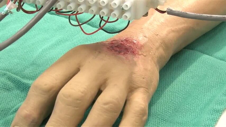 3D Printing Medical Applications to Treat Burned Patients