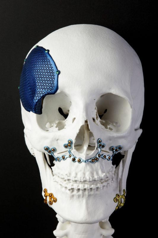 3D Printing skull Bone