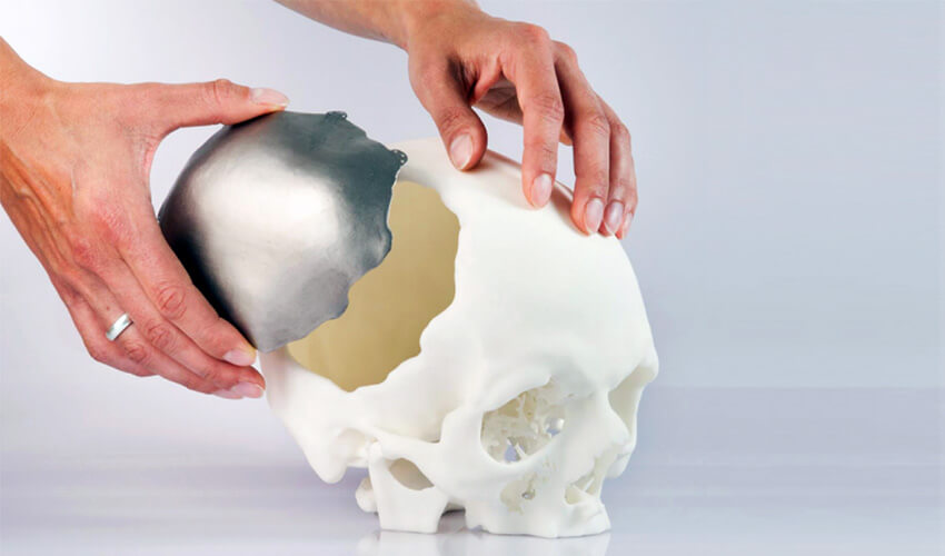 3d printed medical bones